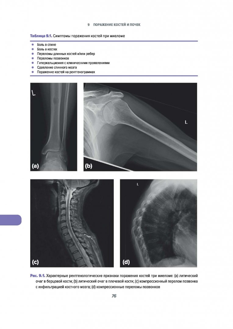 Множественная миелома классификация. Плазмоклеточная миелома. Клинические синдромы при миеломной болезни. Иммуноглобулин при миеломной болезни. Синдромы при миелоломной болезни.